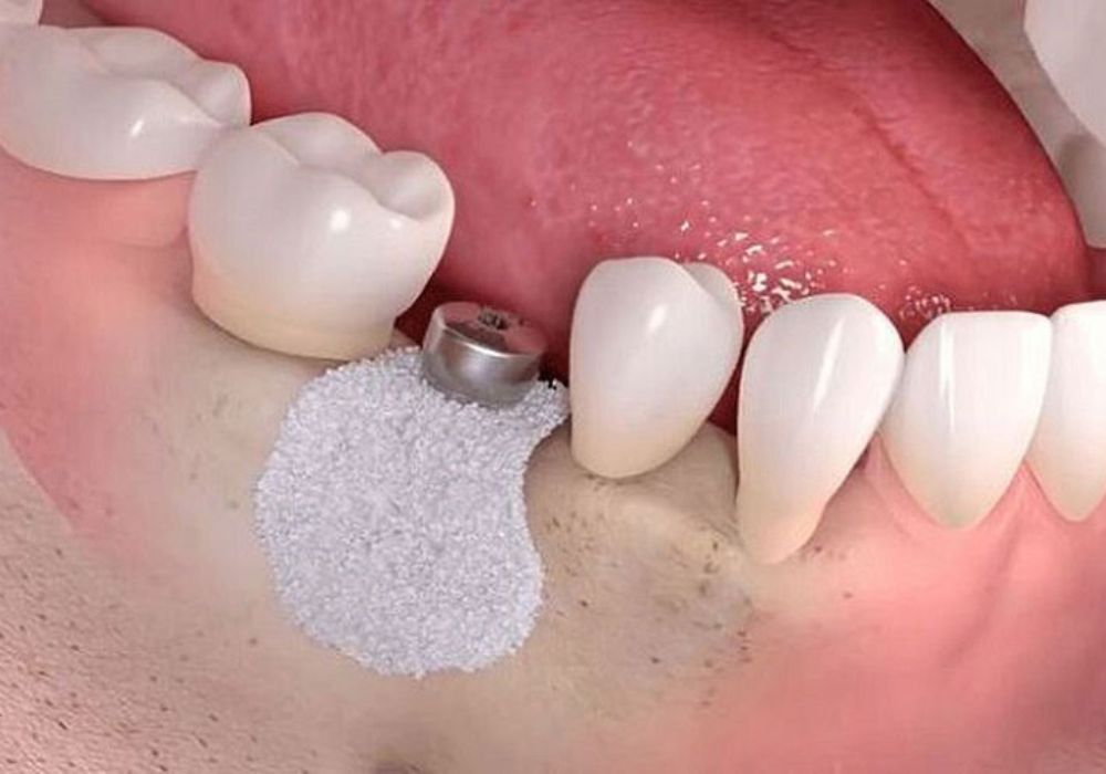 Phẫu thuật cấy ghép Implant thủ công với sự chính xác và tỉ mỉ từ bác sĩ.