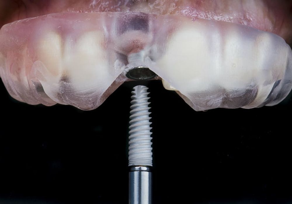 Bác sĩ thực hiện cấy trụ Implant vào xương hàm, chuẩn bị cho quá trình phục hình răng sau này.
