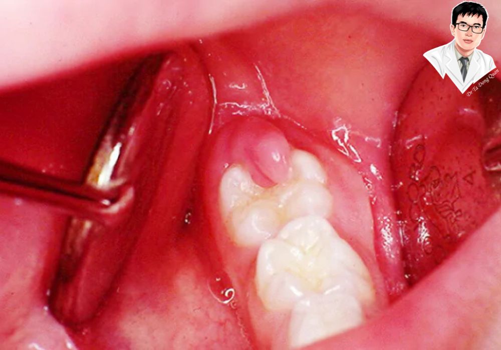 Lợi trùm sưng viêm nghiêm trọng nếu không điều trị kịp thời có thể dẫn đến nhiều biến chứng nguy hiểm.