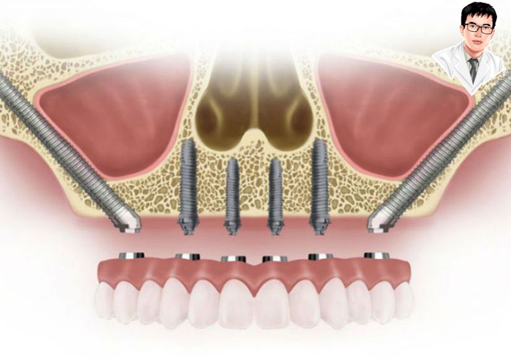 4 trụ – 1 nền móng vững chắc cho toàn bộ hàm răng!