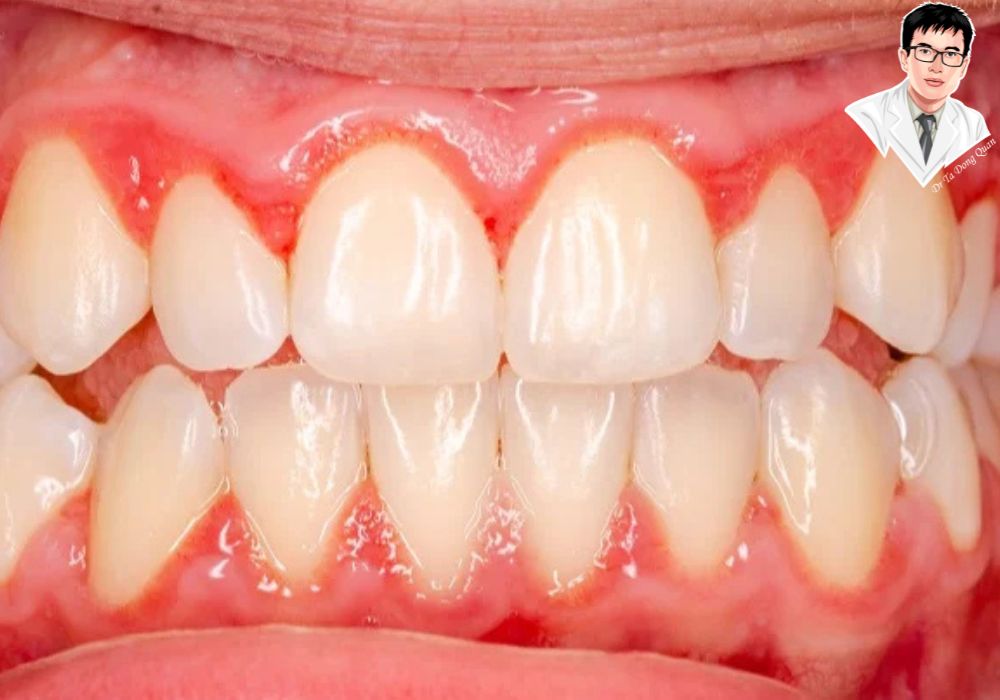 Đừng để lợi bị viêm sưng quá lâu! Nhận diện sớm giúp bạn ngăn ngừa các vấn đề răng miệng nghiêm trọng.