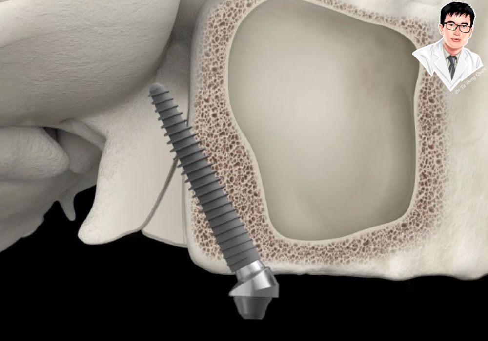 Phóng to cấu trúc mỏm chân bướm phía sau xương hàm trên, nơi trụ implant được neo vững chắc.