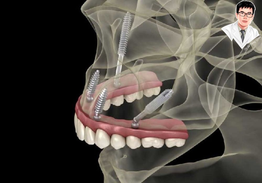 Mô phỏng 3D implant chân bướm trong cấu trúc giải phẫu xương mặt với độ chính xác cao.
