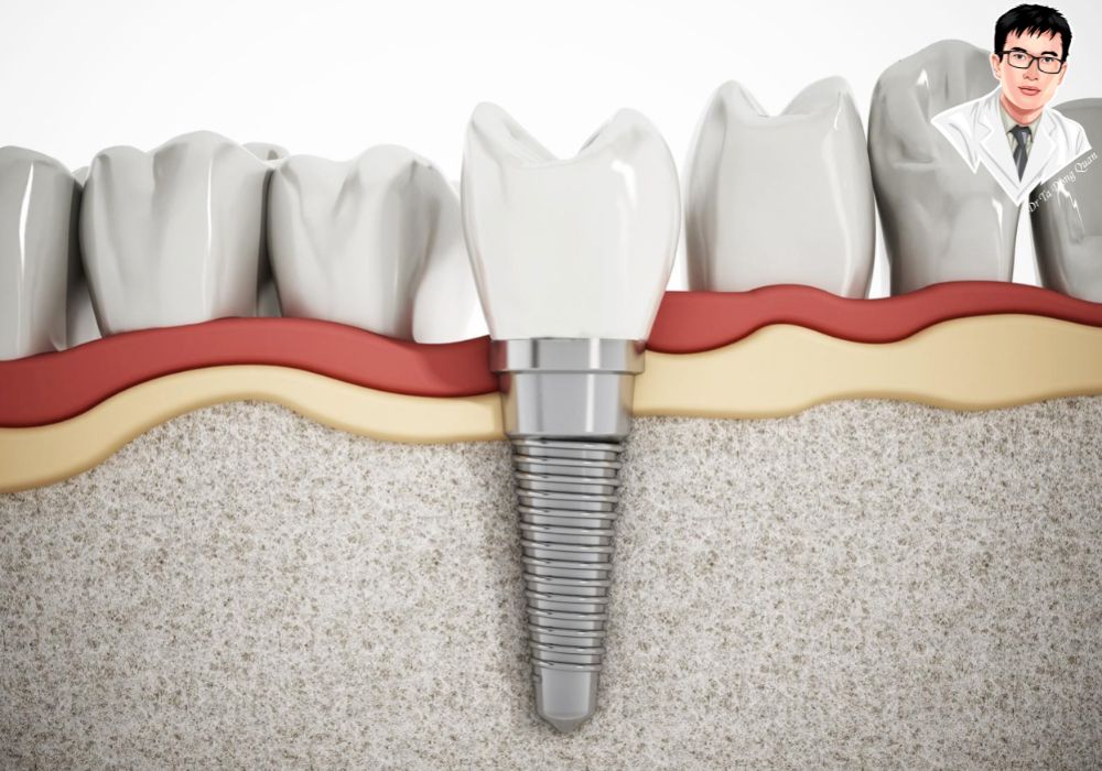 Trình bày kỹ thuật cắm một trụ implant đơn lẻ vào vùng xương hàm, mô tả mô mềm và liên kết với răng sứ.	