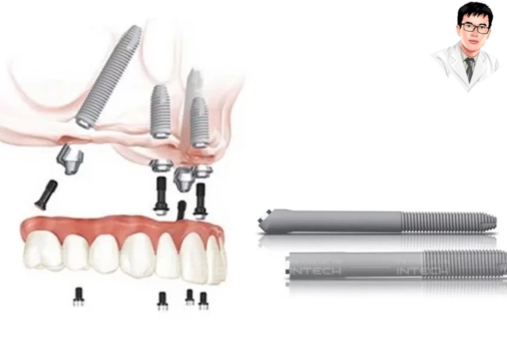 Mô phỏng kỹ thuật cấy ghép implant toàn hàm All-on-4 với cấu trúc trụ implant và hàm giả phục hình cố định.	