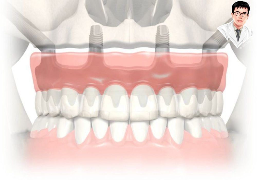 Hình minh họa sự tích hợp giữa trụ implant và xương hàm trong quá trình phục hồi sau cấy ghép toàn hàm.	