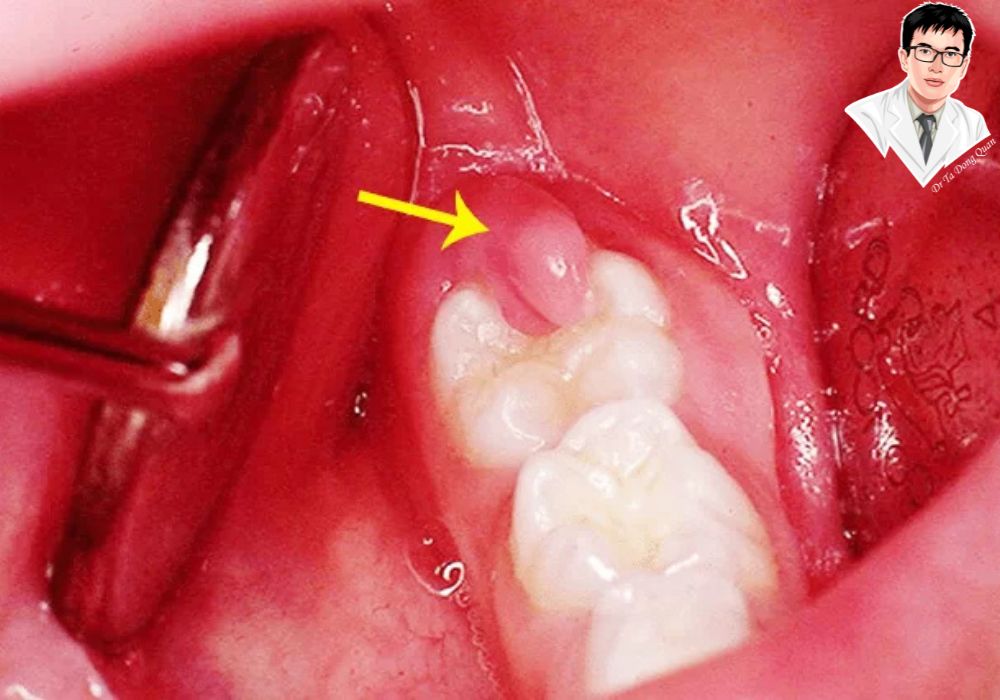 Phẫu thuật cắt lợi trùm giúp giải thoát răng khôn khỏi sự bao phủ của lợi, giảm đau và ngăn ngừa biến chứng