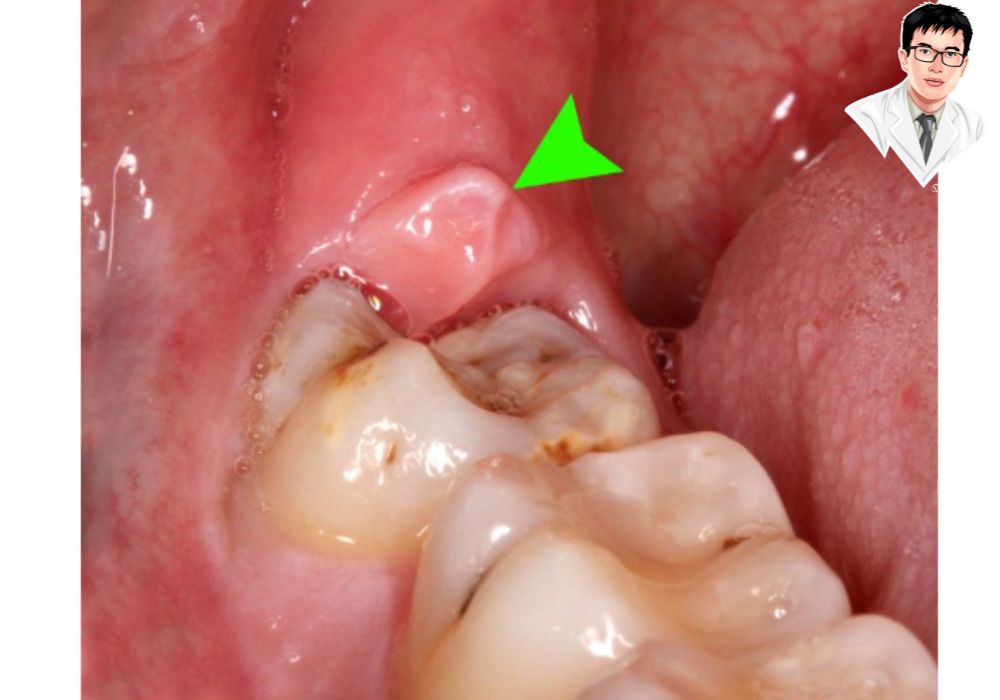 Răng khôn mọc lệch là nguyên nhân chính dẫn đến lợi trùm và nhiều vấn đề nha khoa khác.