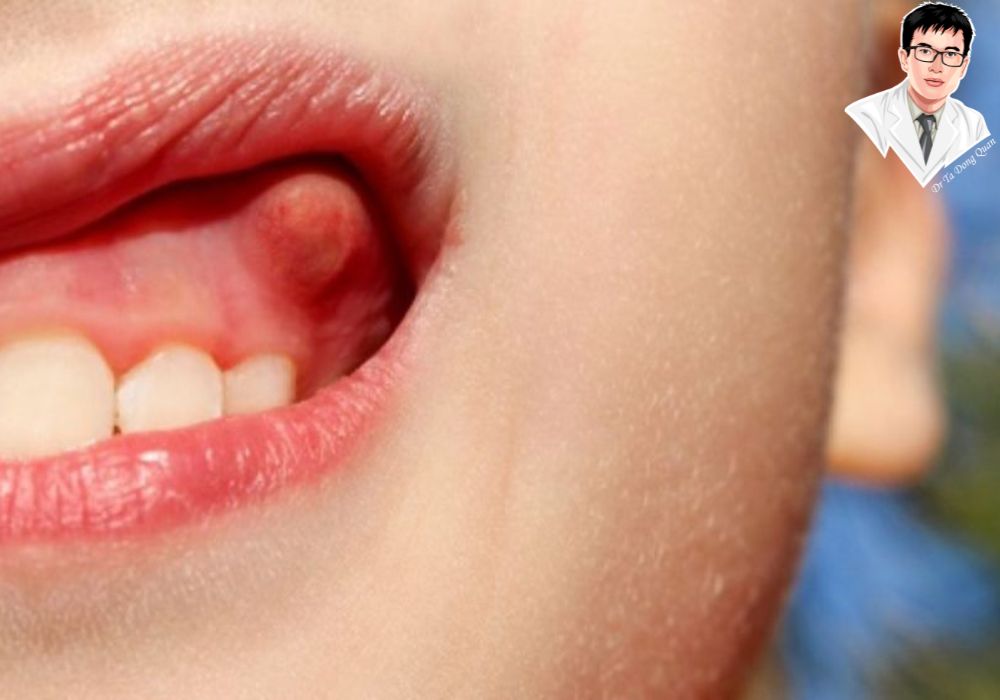 Hiểu rõ cấu trúc răng và lợi trùm giúp bạn nhận biết khi nào cần cắt lợi trùm để bảo vệ sức khỏe răng miệng.