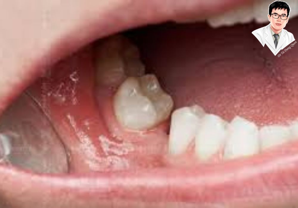 Hình ảnh răng bị mất chưa có biện pháp điều trị, ảnh hưởng đến thẩm mỹ và chức năng ăn nhai.