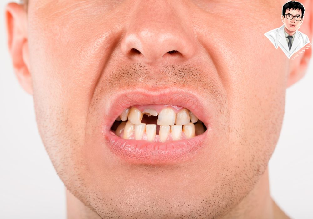 Mất răng lâu năm dẫn đến khó chịu trong việc ăn nhai và tự ti về thẩm mỹ.