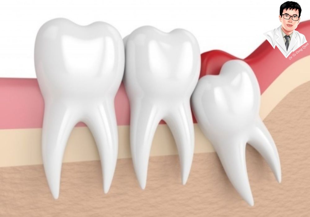 Đau và sưng tại lợi trùm là dấu hiệu phổ biến cần được xử lý kịp thời để tránh nhiễm trùng nặng hơn.