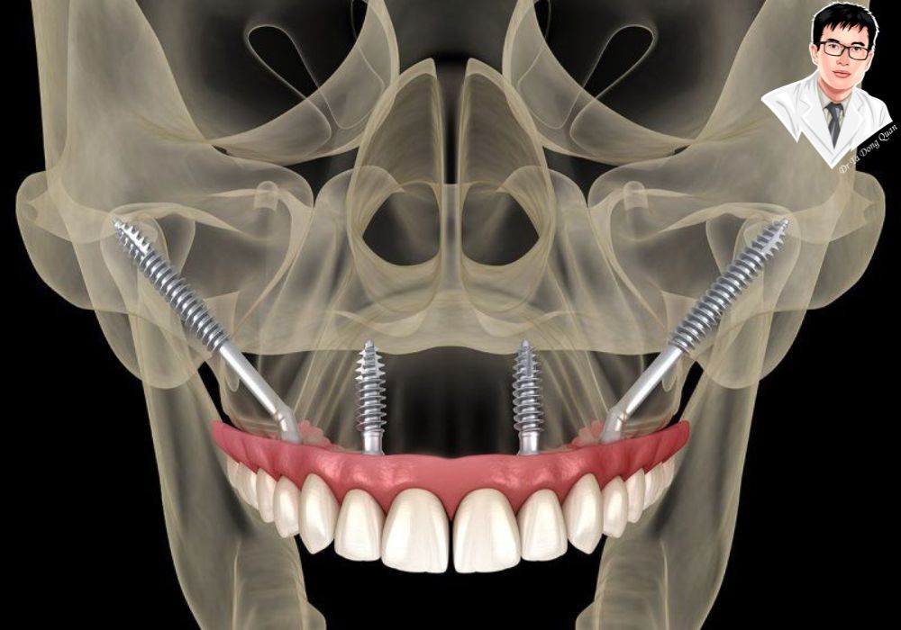 Hình ảnh 3D mô phỏng vị trí cấy ghép implant Zygoma ở hàm trên, cho thấy cấu trúc bám vào xương gò má.	