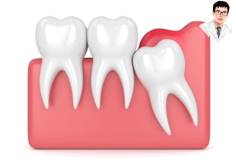 Răng khôn mọc ngầm thường kèm lợi trùm gây đau và cần được theo dõi hoặc can thiệp kịp thời.