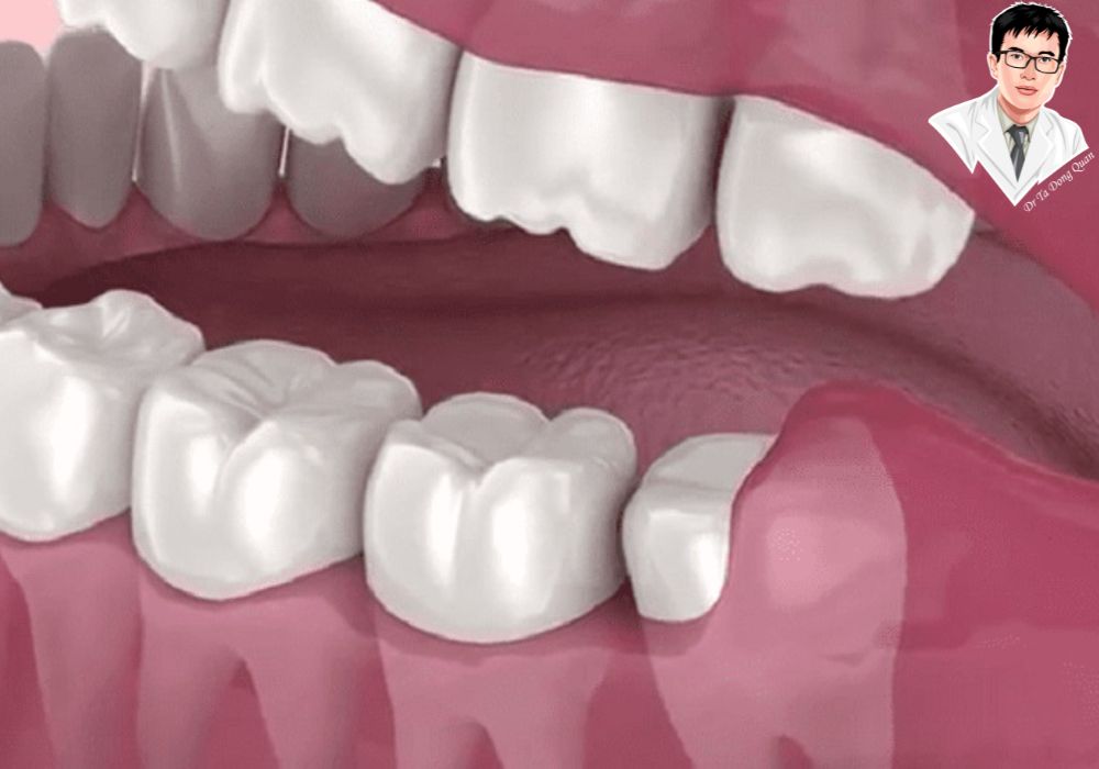 Lợi trùm răng khôn gây sưng đỏ, đau nhức ảnh hưởng sinh hoạt hàng ngày. Nhận biết sớm để có biện pháp xử lý kịp thời! Lợi trùm răng khôn gây sưng đỏ, đau nhức ảnh hưởng sinh hoạt hàng ngày. Nhận biết sớm để có biện pháp xử lý kịp thời!