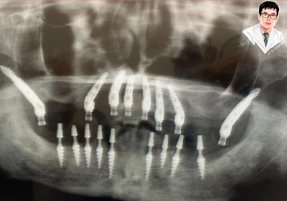 Ảnh chụp X-quang ca cấy implant chân bướm kết hợp implant thông thường ở nhiều vị trí.