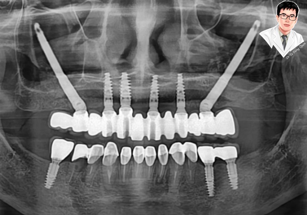 X-quang implant Zygoma hai bên – phù hợp với bệnh nhân tiêu xương hàm nặng.	