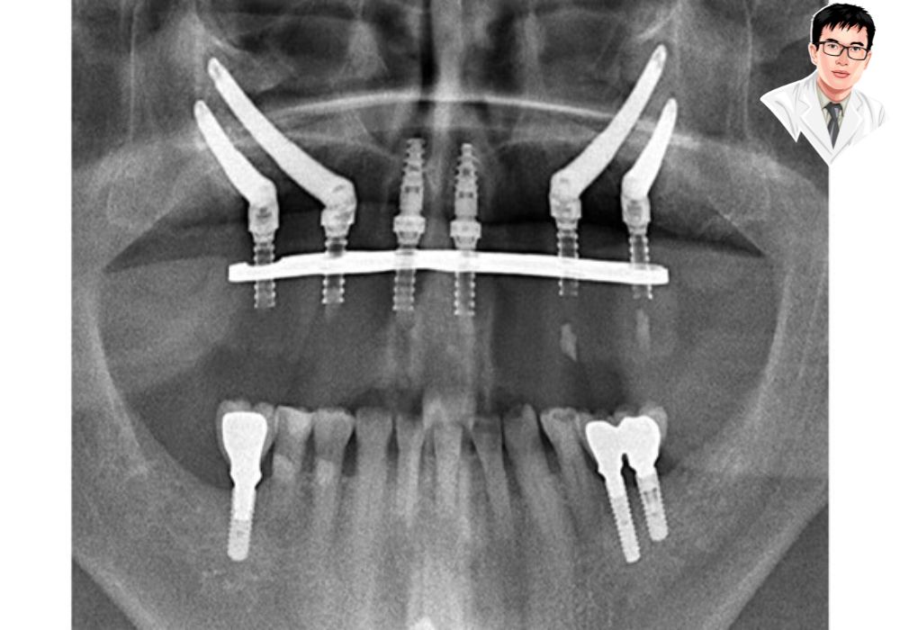 X-quang implant Zygoma hai bên – phù hợp với bệnh nhân tiêu xương hàm nặng.	