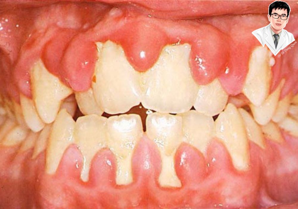 Viêm lợi có thể trở nên nghiêm trọng nếu không được chữa trị kịp thời. Hãy chăm sóc răng miệng để bảo vệ sức khỏe lợi của bạn.