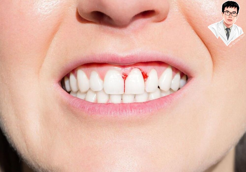 Đừng quên điều trị và chăm sóc đúng cách để có nụ cười rạng rỡ.