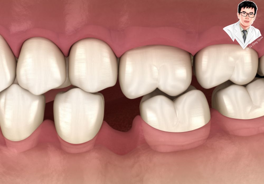 Cầu răng sứ và Implant phục hồi răng mất lâu năm, giúp phục hồi thẩm mỹ và khả năng ăn nhai.