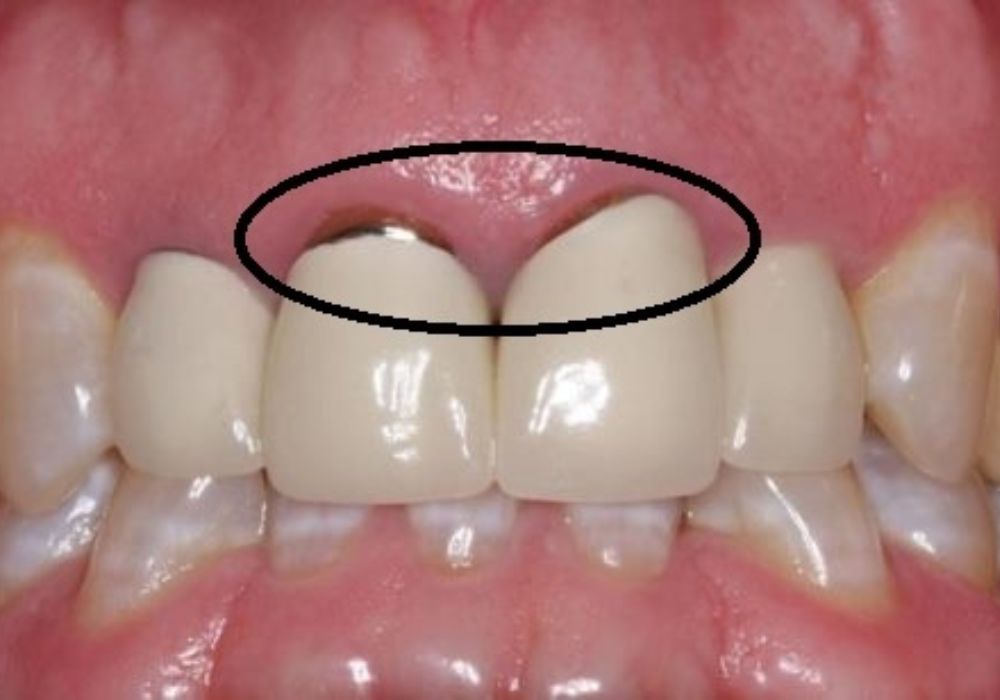 Răng sứ kết hợp với trồng răng giả: Cải thiện nụ cười và chức năng ăn nhai hoàn hảo.