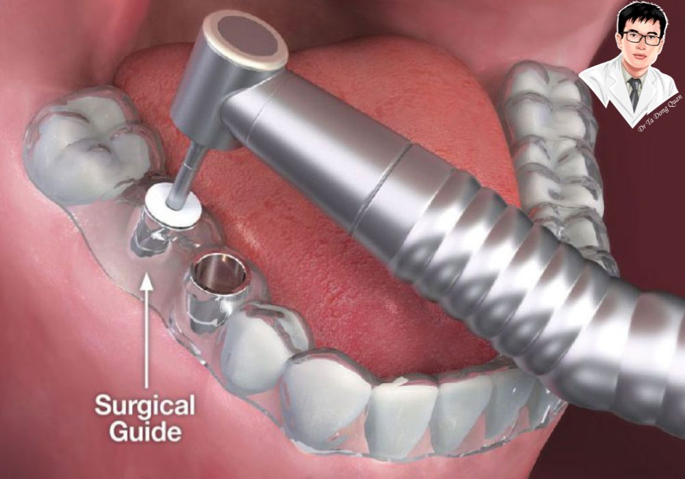 Hướng dẫn phẫu thuật Implant chi tiết, giúp bác sĩ thực hiện cấy ghép chính xác và an toàn