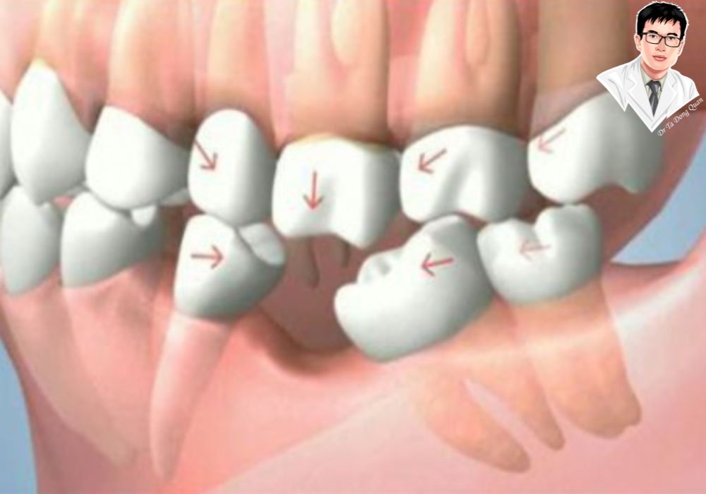 Minh họa quy trình trồng răng Implant, giúp phục hồi chức năng và thẩm mỹ sau khi mất răng lâu năm.