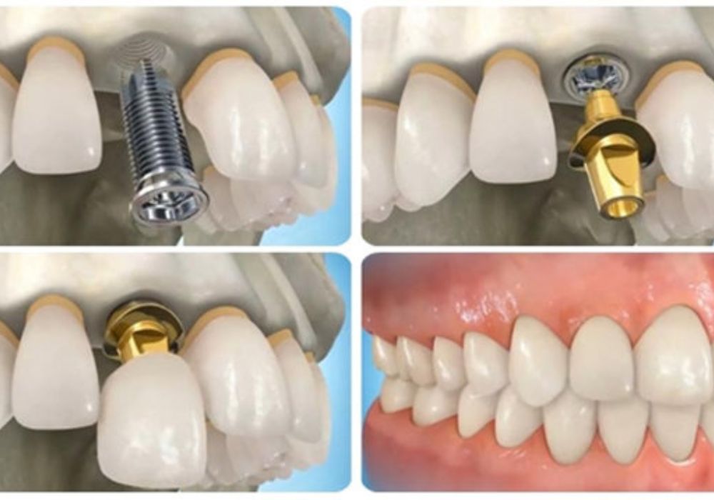 Cấy ghép Implant: Giải pháp dài hạn cho những ai mất răng, bảo vệ xương hàm và tăng cường sức khỏe răng miệng.