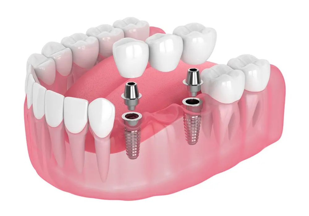 Trồng răng giả Implant và cầu răng sứ: Lựa chọn tối ưu cho sức khỏe và thẩm mỹ. Trồng răng giả Implant và cầu răng sứ: Lựa chọn tối ưu cho sức khỏe và thẩm mỹ.