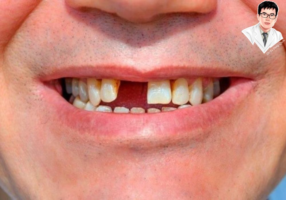 Trồng răng giả Implant: Giải pháp bền vững cho nụ cười khỏe mạnh và tự tin.