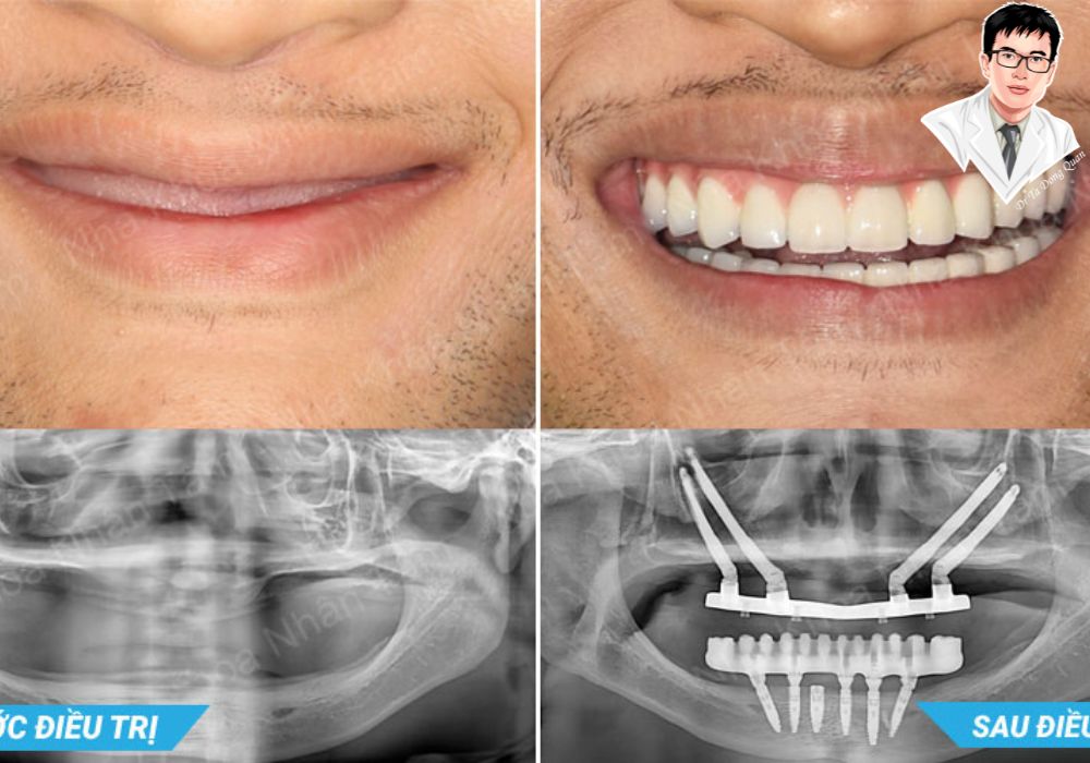 Từ không răng đến nụ cười hoàn hảo chỉ sau vài giờ!