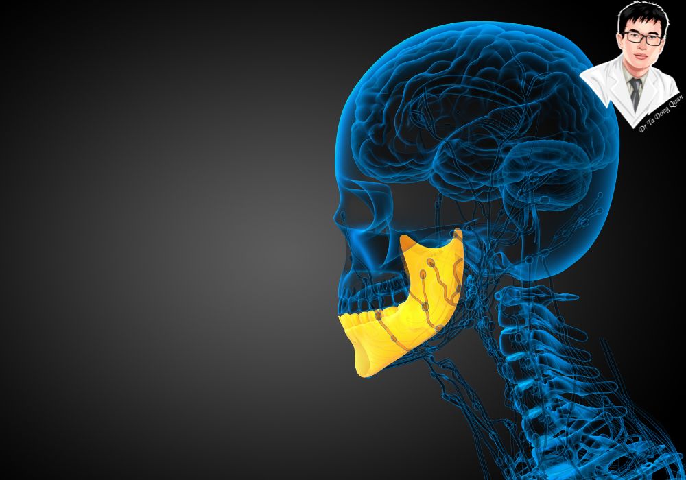 Hình ảnh minh họa vị trí chính xác của trụ implant chân bướm được cắm vào mỏm chân bướm của xương bướm.