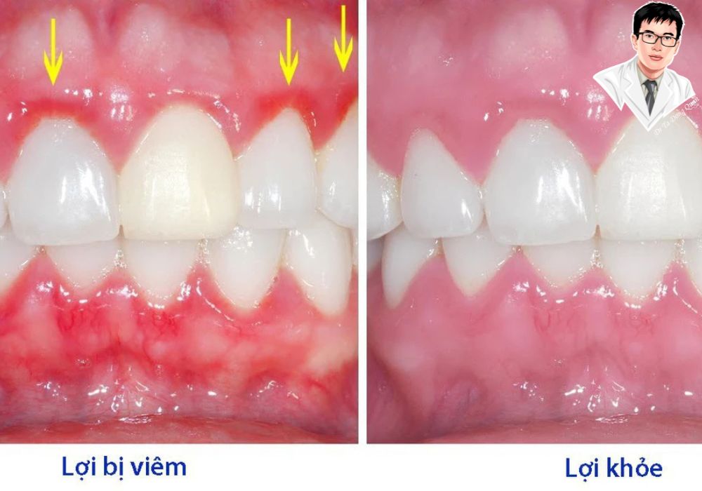 Sau khi điều trị đúng cách, lợi của bạn sẽ khỏe mạnh trở lại! Điều trị sớm để duy trì nụ cười tự tin.