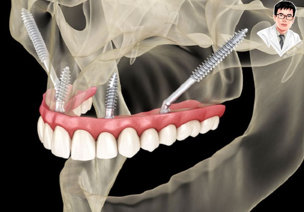 Phục hình răng toàn hàm bằng implant Zygoma, cấy nghiêng và dài để bám vào xương gò má.	