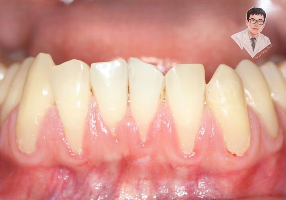 Hình ảnh thực tế của một trường hợp tụt nướu nghiêm trọng, cho thấy phần chân răng bị lộ rõ, dễ bị viêm nhiễm và ê buốt.