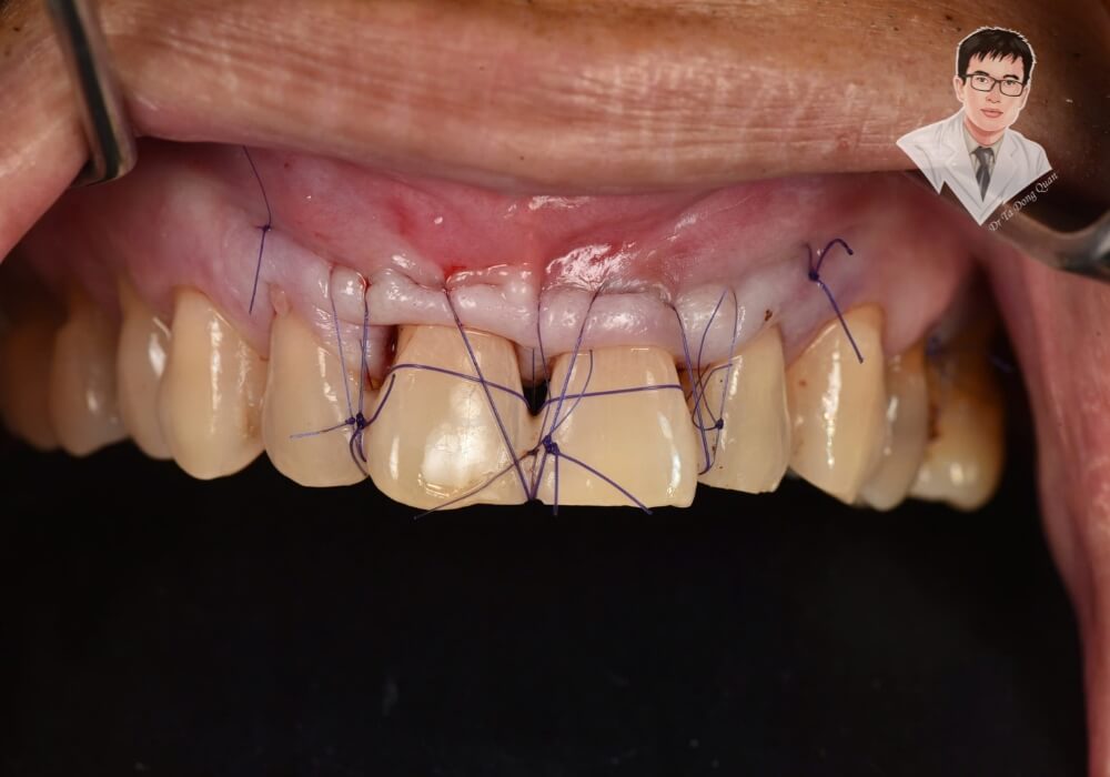  Hình ảnh ca phẫu thuật ghép nướu để điều trị tình trạng tụt nướu răng cửa nghiêm trọng. Các đường chỉ khâu giúp cố định mô nướu mới, phục hồi sức khỏe răng miệng và cải thiện thẩm mỹ.