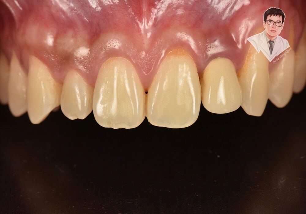 Hình ảnh sau khi điều trị tụt nướu răng cửa, cho thấy phần mô nướu đã được phục hồi, che phủ chân răng, giúp răng chắc khỏe hơn và cải thiện thẩm mỹ đáng kể. Đây là kết quả sau khi phẫu thuật ghép nướu hoặc áp dụng các phương pháp điều trị chuyên sâu.