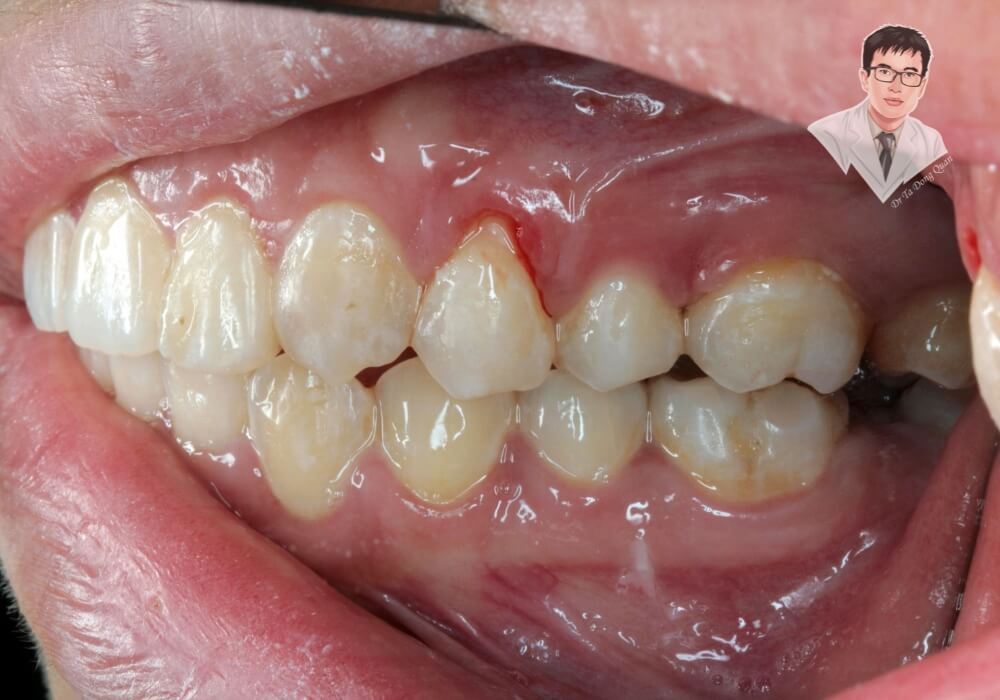 Hình ảnh tình trạng tụt lợi nghiêm trọng, lộ chân răng, có thể gây ê buốt và mất răng nếu không điều trị kịp thời.