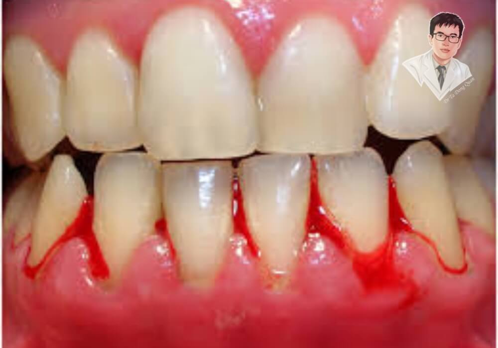  Hình ảnh cận cảnh nướu bị viêm nhiễm nặng, chảy máu và tụt lợi nghiêm trọng, lộ rõ chân răng.