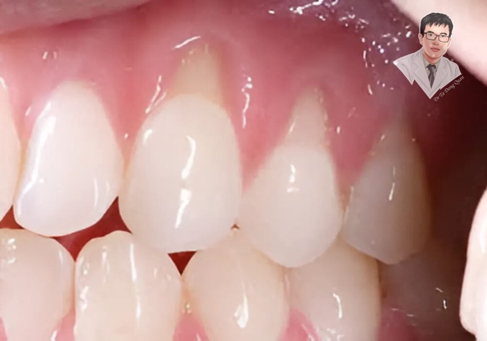 Hình ảnh một trường hợp tụt nướu nghiêm trọng, cho thấy nguy cơ ảnh hưởng đến chân răng và sức khỏe răng miệng nếu không được điều trị sớm.