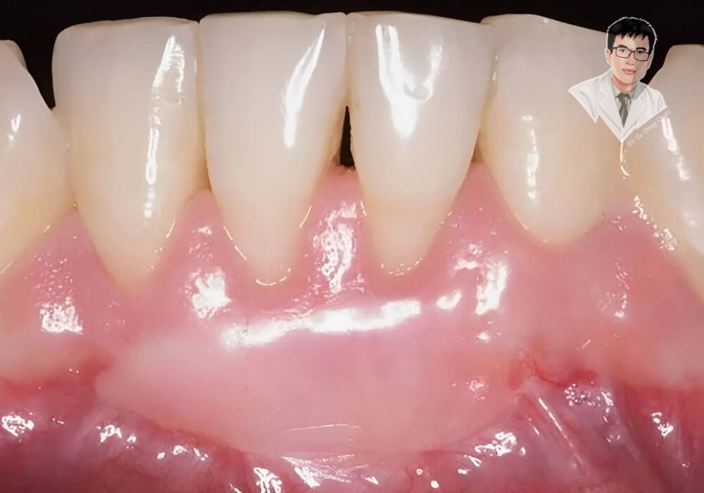 Bạn có thấy răng mình bị tụt nướu như thế này? Đừng bỏ qua dấu hiệu này, tìm hiểu ngay cách chữa trị hiệu quả! Hình ảnh mô tả tình trạng tụt nướu răng với chân răng bị lộ rõ, gây ê buốt và mất thẩm mỹ. Đây là dấu hiệu nhận biết sớm cần điều trị kịp thời.