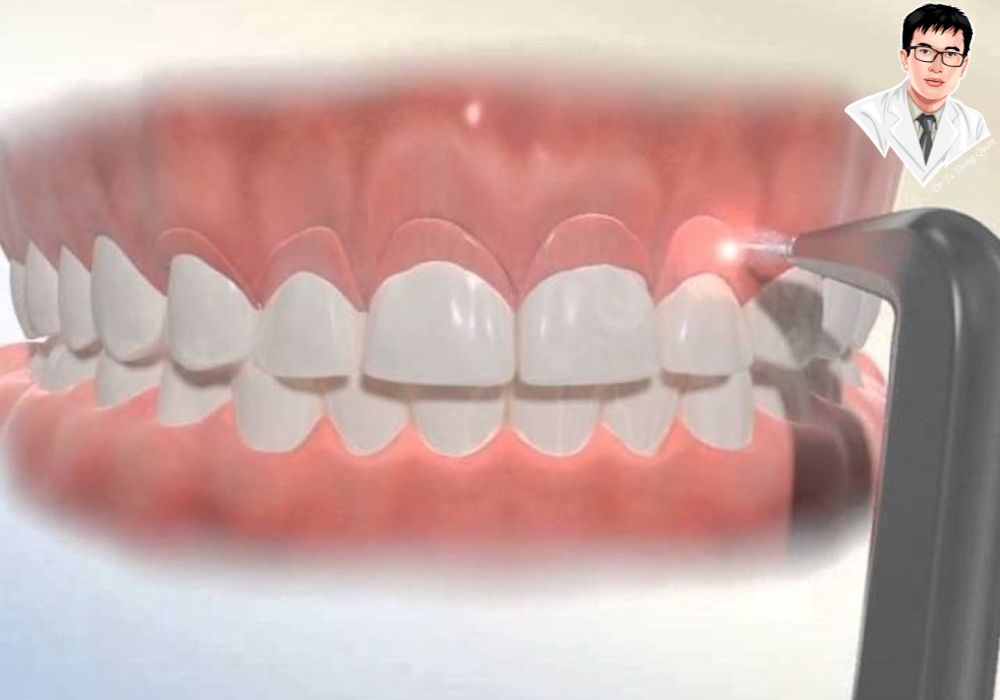 Hình ảnh máy laser trong quá trình cắt lợi, tượng trưng cho công nghệ tiên tiến	