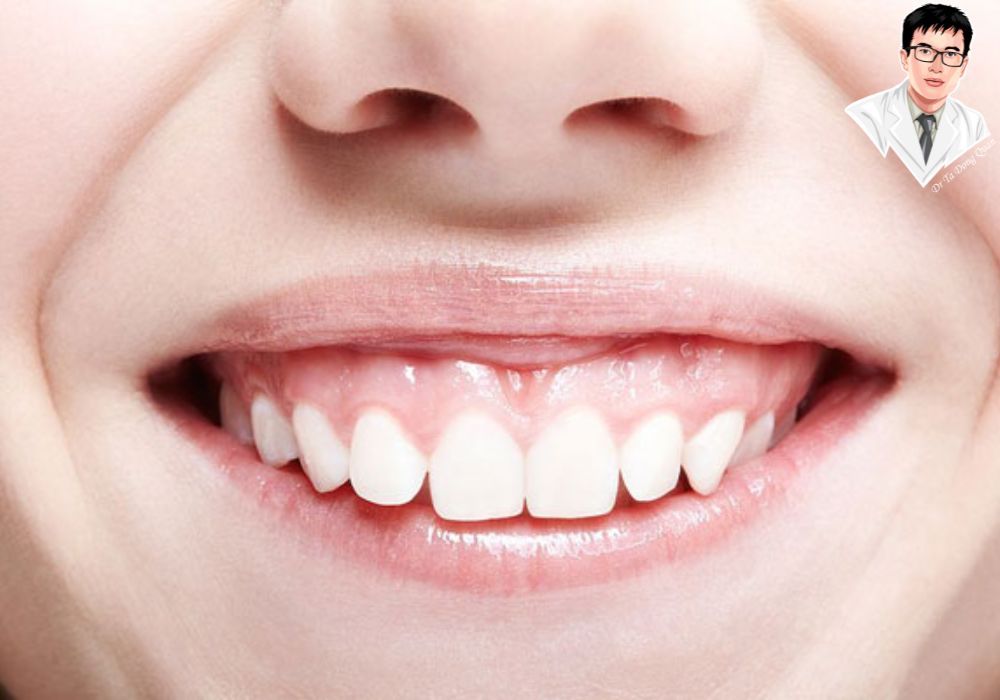 Cắt lợi thẩm mỹ giúp nụ cười tự tin và hài hòa – Giải pháp tối ưu cho người cười hở lợi.