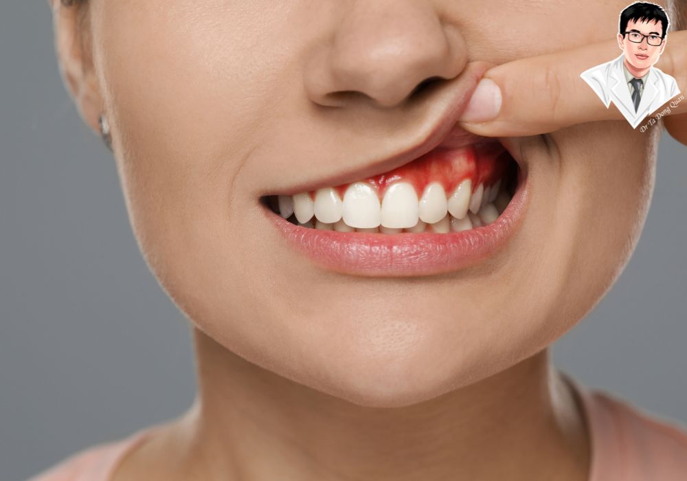 Lợi sưng đỏ, chảy máu – Dấu hiệu cần thăm khám và cắt lợi kịp thời để bảo vệ sức khỏe răng miệng.