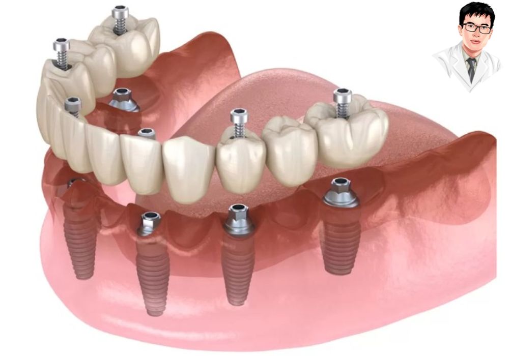  Với 6 trụ implant, All On 6 giảm áp lực lên từng trụ, giúp giảm thiểu nguy cơ trụ implant bị quá tải. 