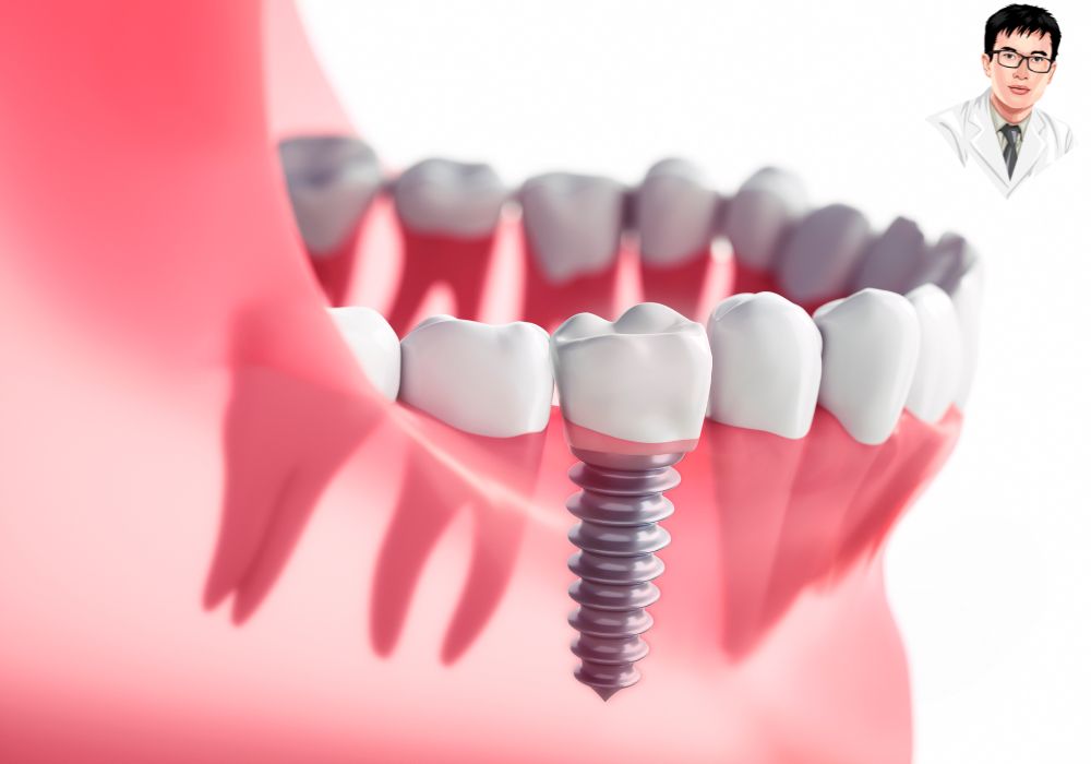 Kỹ thuật cấy ghép implant răng – giải pháp phục hồi răng tối ưu, bền chắc như răng thật.