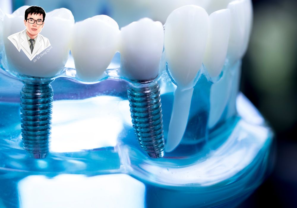 Phục hình implant răng thẩm mỹ, khôi phục chức năng ăn nhai tự nhiên.
