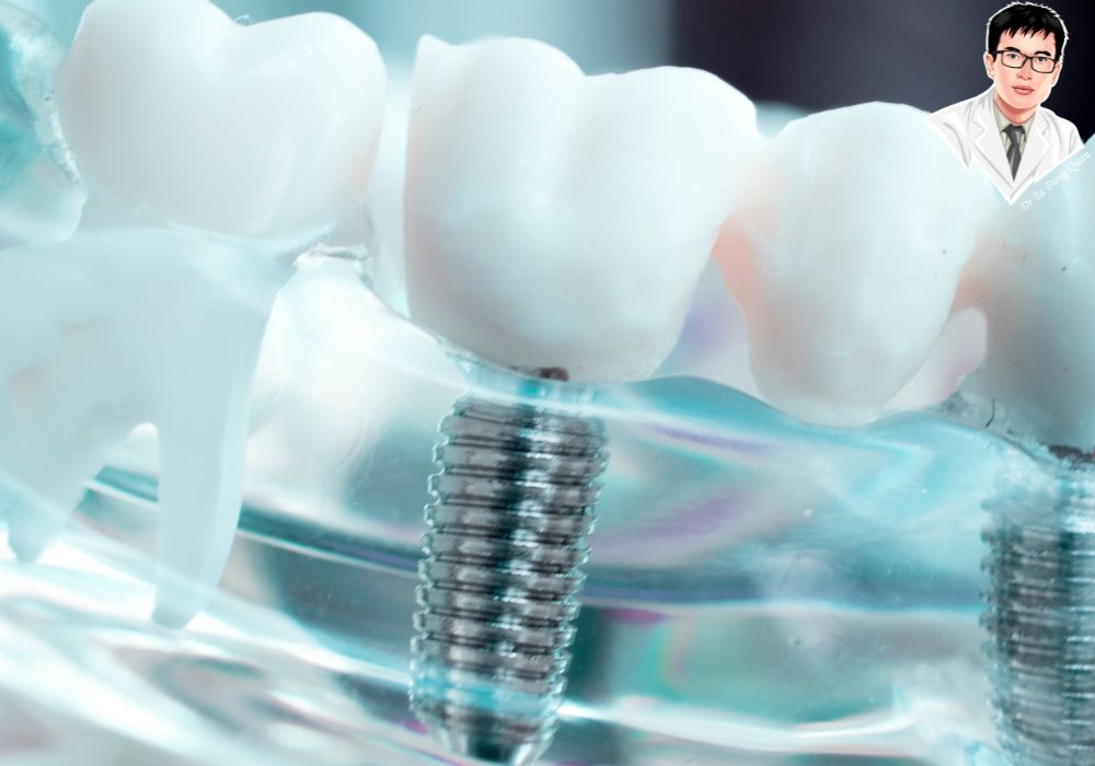 Mô hình 3D hiển thị trụ implant răng và các răng kế cận trong hàm, giúp hình dung rõ cấu tạo giải phẫu.