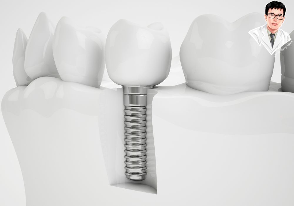 So sánh cấu trúc và chức năng giữa trụ implant và răng thật – gần như tương đồng